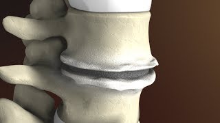 Low Back Pain  Disc Herniation  Everything You Need To Know  Dr Nabil Ebraheim [upl. by Anura]