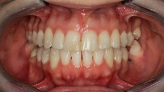 Invisalign Time Lapse [upl. by Ybreh]