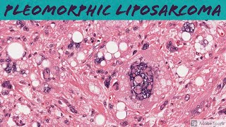 Dedifferentiated liposarcoma with heterologous osteosarcoma component [upl. by Hammond]