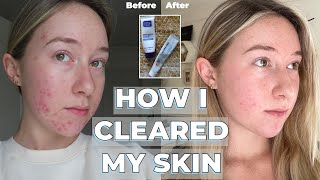 Adapalene Gel amp Benzoyl Peroxide transformation  skincare routine  HOW I CLEARED MY SKIN [upl. by Oinota]