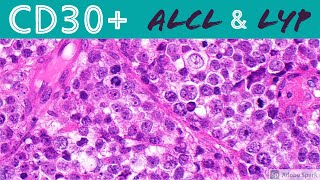 Anaplastic Large Cell Lymphoma amp Lymphomatoid Papulosis CD30 Positive Lymphoproliferative Disorders [upl. by Thaddeus]