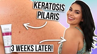 How I Treat My Keratosis Pilaris on Arms NO MORE DRY BUMPY SKIN [upl. by Elleinaj]