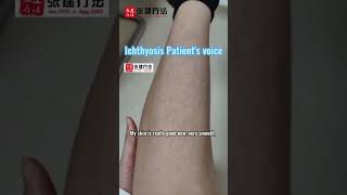 Ichthyosis Patients voice IchthyosisVulgaris LamellarIchthyosis ErythrodermIcichthyosis dryskin [upl. by Beaudoin]