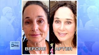 See Woman’s Incredible Before and After Facial Rejuvenation [upl. by Elon]