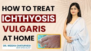 How to Treat Ichthyosis Vulgaris at Home  Home Remedies for Ichthyosis Vulgaris Fish Skin [upl. by Leahcim]