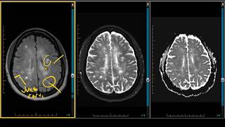 Demyelination Case Review  ADC Negative Multiple Sclerosis [upl. by Nwahsiek]