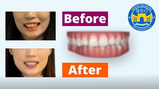 Invisalign Before and After Correcting Bite [upl. by Earla]