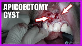 Apicoectomy Cyst SURGERY [upl. by Nodnorb293]