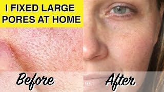 DIY LARGE PORES TREATMENT At Home Glycolic Acid Peel Dramatically Reduces Pores amp Wrinkles [upl. by Ahsinyt]