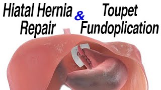 Hiatal Hernia Repair with Toupet Fundoplication to Treat Reflux Animation [upl. by Isidoro]