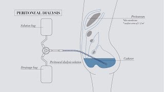 Understanding peritoneal dialysis [upl. by Anawt]