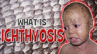 What is Ichthyosis  Cause Symptoms amp Treatment [upl. by Olga]