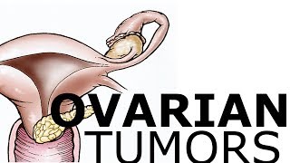 Ovarian Pathology amp Tumors [upl. by Nelleoj]