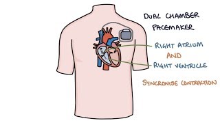 Understanding Pacemakers [upl. by Shaper]