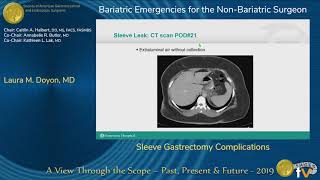 Sleeve Gastrectomy Complications [upl. by Clinton511]