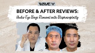 Before and After Under Eye Bags Removal with Blepharoplasty  Wave Plastic Surgery [upl. by Ayikin]