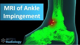 MRI of Anterior Ankle Impingement [upl. by Nitneuq]