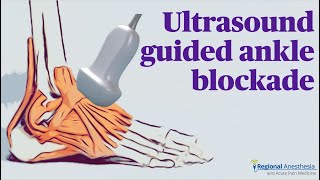 Ultrasound Guided Ankle Block [upl. by Brookes274]