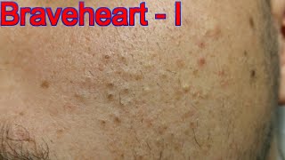 Extraction for Teenage Acne  Part 1 of 3 [upl. by Beatty]