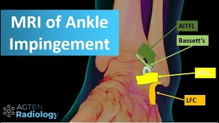 MRI of Anterolateral Ankle Impingement [upl. by Maurene839]