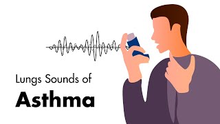 Sounds of Asthma  Wheezing Lung Sounds [upl. by Chere]