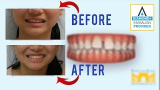 Invisalign Before and After Gap in Teeth [upl. by Sperry104]