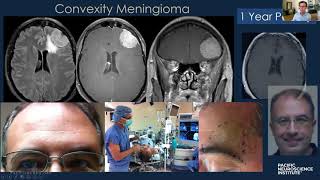 Keyhole Meningioma Removal with Dr Daniel Kelly [upl. by Ocsic331]