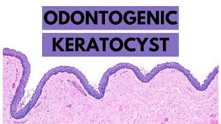 Odontogenic Keratocyst Clinical features Radiology Histology and Treatment [upl. by Nnylylloh]