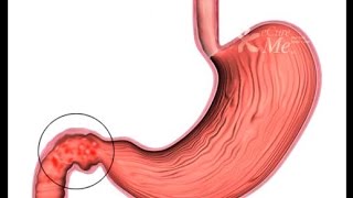 DUODENITIS INFLAMACIÓN DEL DUODENO [upl. by Imuy]