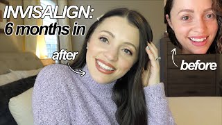 THE TRUTH ABOUT INVISALIGN  Before  After 6 months  FAQ Answered [upl. by Ibbor305]