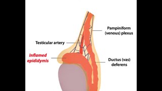 Epididymitis [upl. by Accem163]