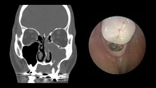 Odontogenic Sinusitis Sinus Surgery First [upl. by Ainnet]