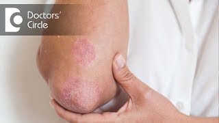 What is contact dermatitis  Patient Explainers [upl. by Girvin]