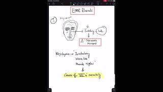 Case 4 Orbicularis Myokymia  Facial Nerve Overactivity [upl. by Neibart]