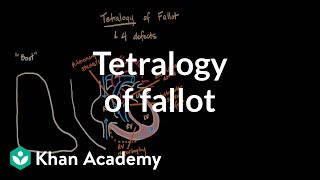 Tetralogy of fallot  Circulatory System and Disease  NCLEXRN  Khan Academy [upl. by Athey]