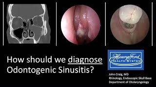 Diagnosing Odontogenic Sinusitis International Consensus [upl. by Erminie472]