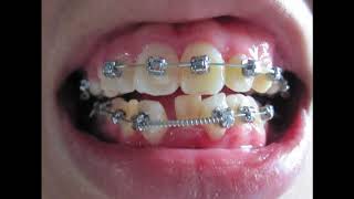 Braces  Before and After Time Lapse [upl. by Niki]