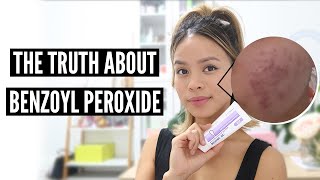 Clear Acne With Benzoyl Peroxide Pros and Cons [upl. by Nylarej]