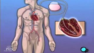 Permanent Pacemaker Implant Surgery [upl. by Assetal986]