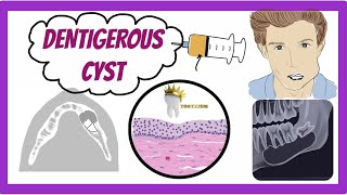 ORAL PATHOLOGY  DENTIGEROUS CYST [upl. by Annaigroeg]