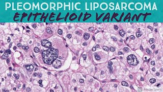 Pleomorphic Liposarcoma Epithelioid Variant [upl. by Lahcar]