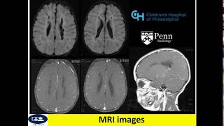 Periventricular leukomalacia in CT and MRI [upl. by Kcirdneked]