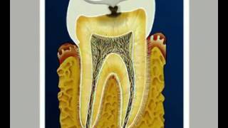 Как развивается кариес [upl. by Arndt]