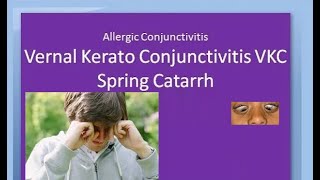 Ophthalmology 088 a Vernal KeratoConjunctivitis VKC Spring Catarrh Allergic Horner Tranta Eye [upl. by Kern897]