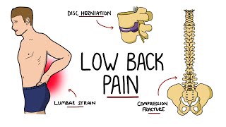 Low Back Pain Explained Including Red Flags [upl. by Emery]