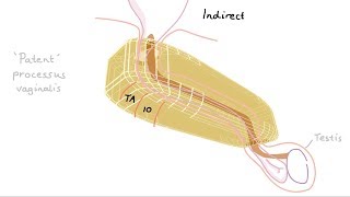 Inguinal Hernia Repair Surgery Risks and Outcomes  CHI Health [upl. by Ymmit828]