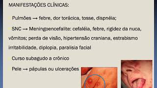 Aula Cryptococcus Famed Sobral [upl. by Yanrahs]