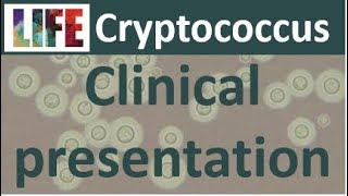 Cryptococcosis clinical presentation [upl. by Drofwarc989]