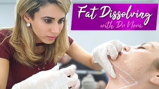 Double Chin Fat Dissolving Treatment  NonSurgical Liposuction [upl. by Ahsikcin]