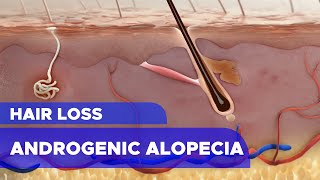 Hair Loss Androgenic Alopecia [upl. by Maxa]